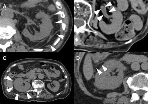 Added value of non-contrast CT for the diagnosis of acute pyelonephritis in older patients with ...