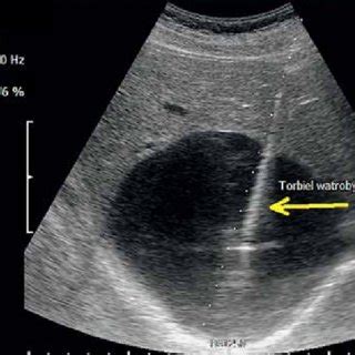 Percutaneous ultrasonography. Cyst of the right lobe of the liver ...