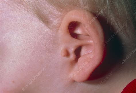 Auricular (ear) appendage: a congenital deformity - Stock Image - M350/0142 - Science Photo Library