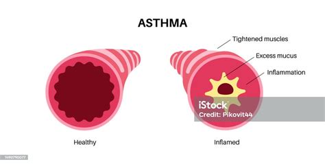 Asthma Lung Disease Stock Illustration - Download Image Now - Allergy ...