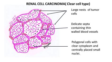 RENAL CELL CARCINOMA- CLEAR CELL TYPE - Pathology Made Simple