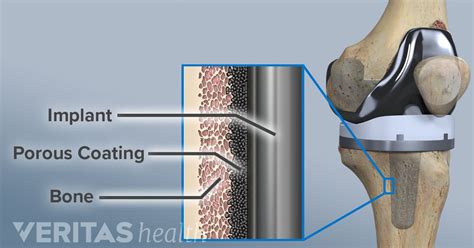 The Pros and Cons of Double Knee Replacement