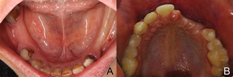 Preoperative view of both the maxilla and mandible. | Download Scientific Diagram