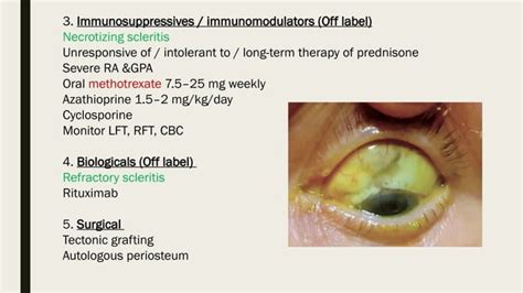 Episcleritis & Scleritis (causes, clinical features, treatment).pptx