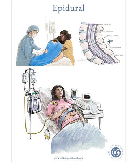 Epidural Chart | Birth International