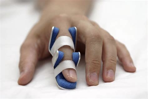 Broken Finger - Causes, Symptoms, Diagnosis and Treatment