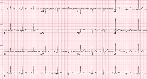 Story of an Unfortunate Fall: Cardiac Contusion Presenting with an ...