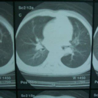 Chest CT scan showing bilateral mediastinal lymphadenopathy. | Download Scientific Diagram