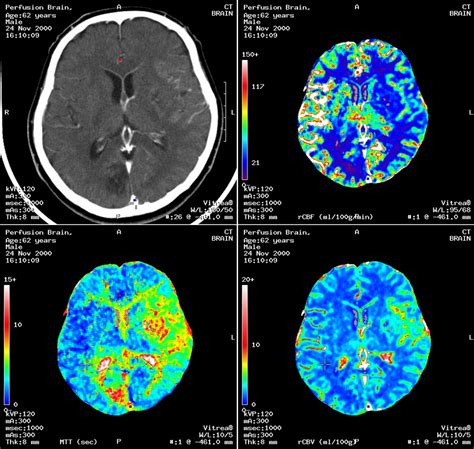 Brain Aneurysm Ct Scan - Diagnosis of a brain aneurysm may require ct scans, lumbar puncture, or ...