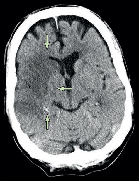 Current practice and future directions in the diagnosis and acute treatment of ischaemic stroke ...