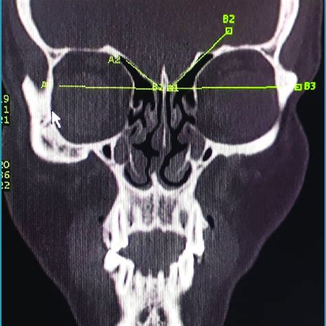 Take-off angle of the ethmoid roof from horizontal plane of CT scan... | Download Scientific Diagram