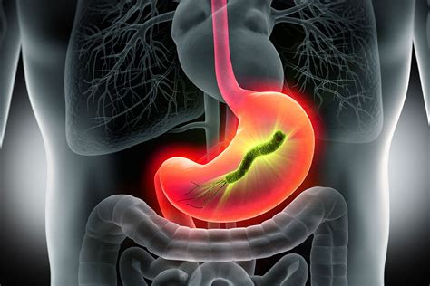 Is It Something I Ate or is There a Hidden Bacteria in My Stomach? - Prestige Medical Group