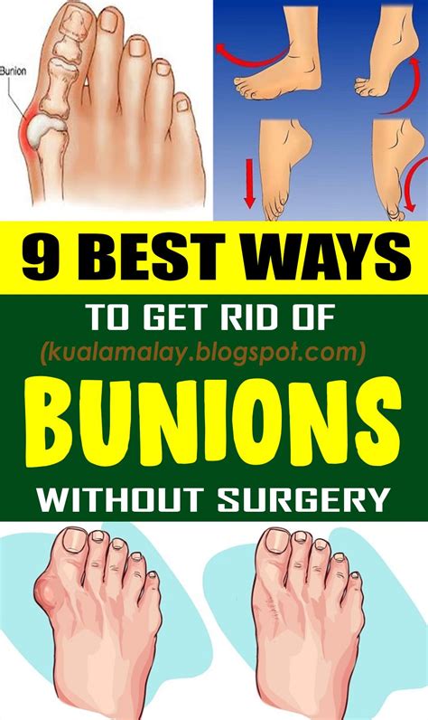 How to Get Rid of Bunions Without Surgery? | Get rid of bunions, Bunion ...