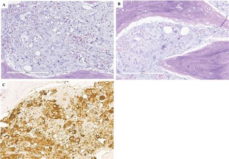 Patient 1, trephine biopsy histology. A, multiple large megakaryocytes ...