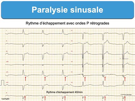 Syndrome Bradycardie Tachycardie E Cardiogram | Images and Photos finder