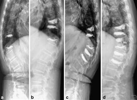 The patient was a 74-year-old woman with severe osteoporosis (T-score,... | Download Scientific ...