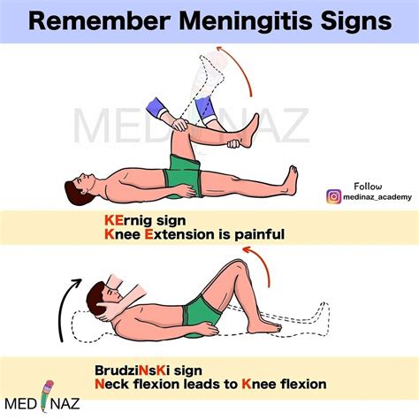 Kernig Sign and Brudzinski Sign - Mnemonic