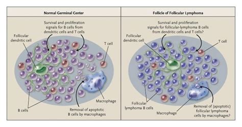 Prognosis in Follicular Lymphoma — It's in the Microenvironment | NEJM