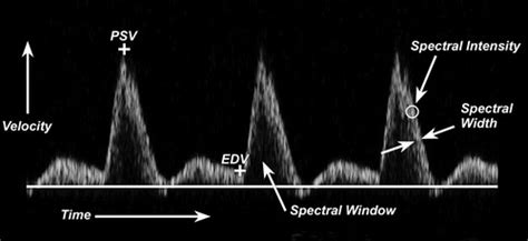 Normal Doppler Spectral Waveforms of Major Pediatric Vessels: Specific Patterns | RadioGraphics