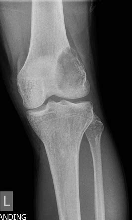 Lucent/lytic bone lesion - differential diagnosis (mnemonic) | Radiology Reference Article ...