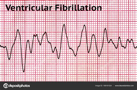 Que Es Fibrilacion Atrial