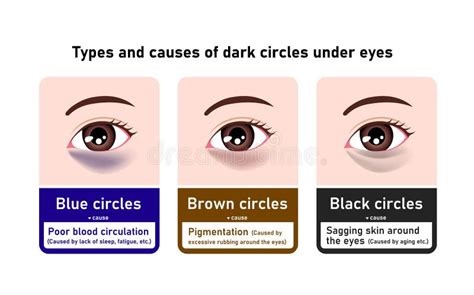 Types and Causes of Dark Circles Under Eyes. Vector Illustration Stock Vector - Illustration of ...