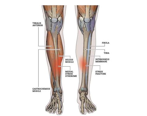 Exertional Shin Pain or 'Shin Splints'