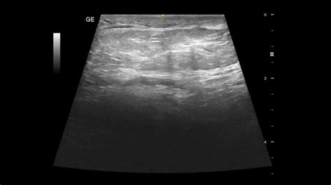 Spermatic Cord Lipoma | Ultrasound Case | GU | - YouTube