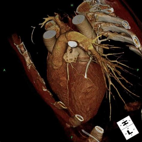 How Long After Angiogram Can I Exercise (And Why)?