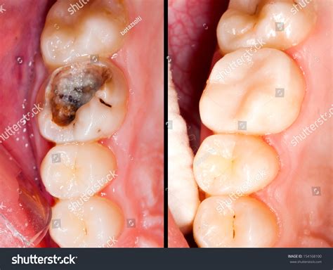 Decayed Tooth Before After Restorative Treatment Stock Photo 154168100 ...