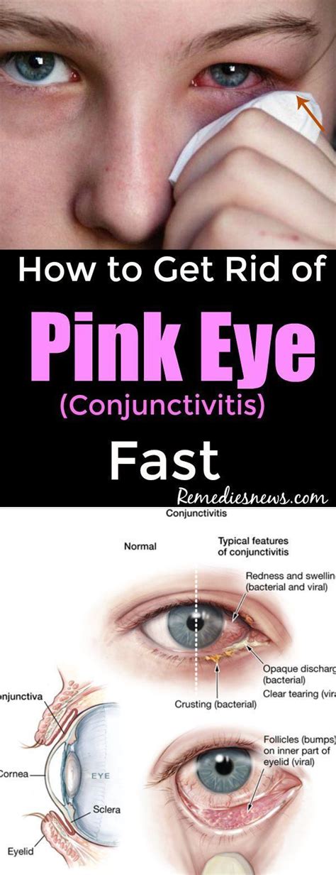 How to Get Rid of Pink Eye (Conjunctivitis) Fast | Pink eyes, Pink eye home remedies, Bacterial ...