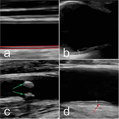 Frontiers | High-Frequency Ultrasound of Multiple Arterial Areas ...