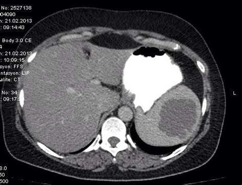 CT scan of the abdomen. Splenic multiloculated cystic lesion ...