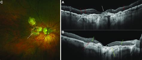 OCT findings in geographic atrophy age-related macular degeneration. A ...