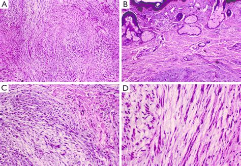 Histology of the neurofibroma with mucinous degeneration (H&E... | Download Scientific Diagram