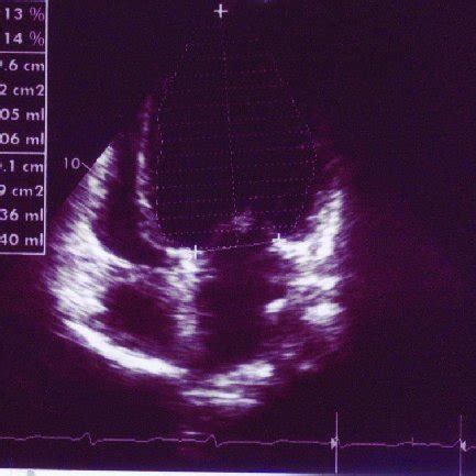 Transthoracic Echocardiography Demonstrated Global Hypokinesia of the... | Download Scientific ...