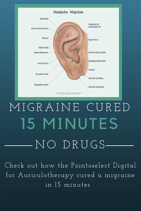 Auriculotherapy for Migraine | Acupuncture, Migraine, Migraine headaches