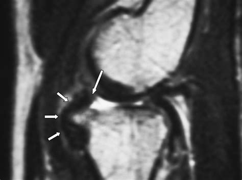 MRI, Arthroscopy, and Histologic Observations of an Annular Ligament Causing Painful Snapping of ...