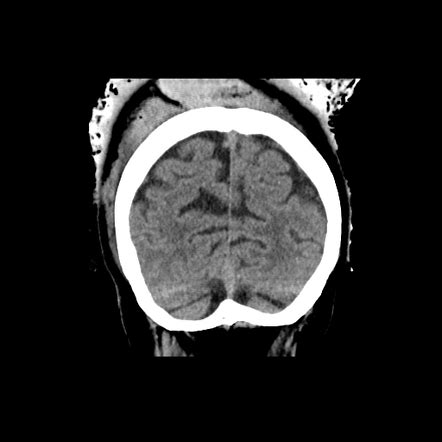 Subgaleal Hemorrhage Ultrasound