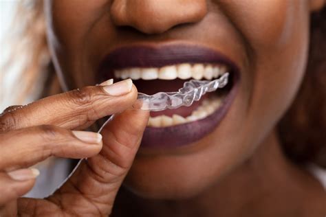 Invisalign treatment process: how it works