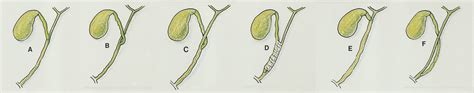 The Cystic Duct: Normal Anatomy and Disease Processes | RadioGraphics