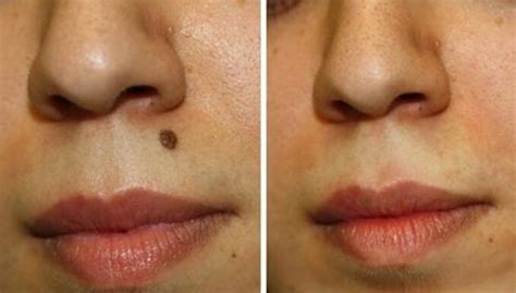 10 Natural Home Remedies to Get Rid of Moles on Your Face