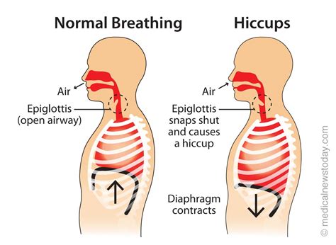 Is There a Cure to Hiccups? | SiOWfa15: Science in Our World: Certainty and Controversy