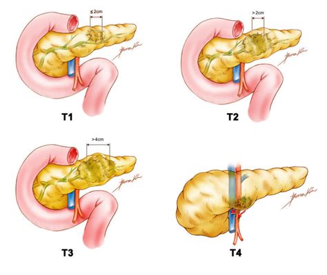 Stage & Grade - Pancreatic Cancer | Johns Hopkins Pathology