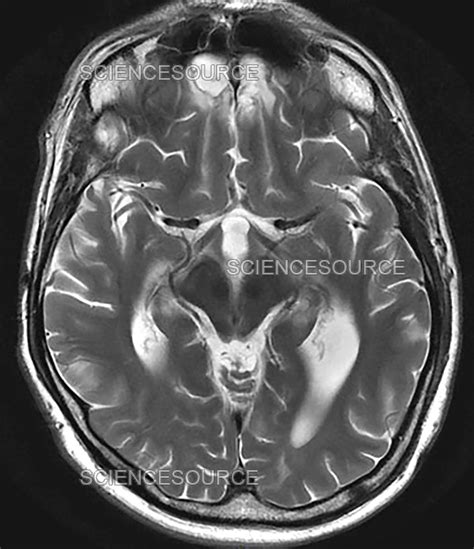 Photograph | Chronic Post-Traumatic Brain Injury, M | Science Source Images