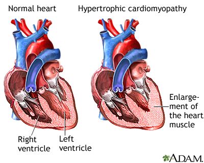 Cardiomyopathy: MedlinePlus Medical Encyclopedia