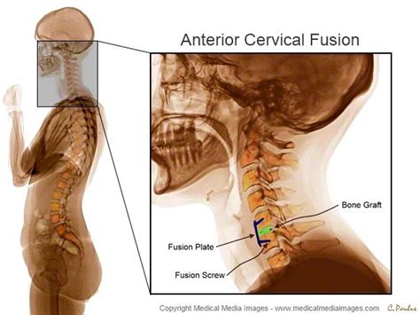 Color X-Ray Medical Image showing a Cervical Fusion Surgery (ACDF). Ideal for Medical Websites ...