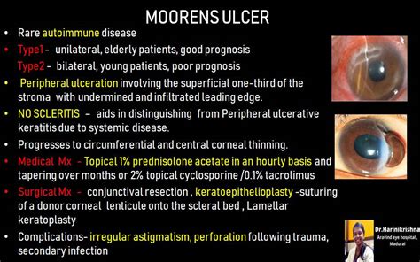 Moorens Ulcer - EyeToday