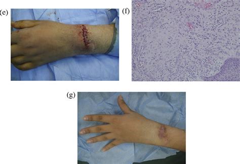 (a) The granuloma at the site of the dorsal wrist scar. (b) Negative ...