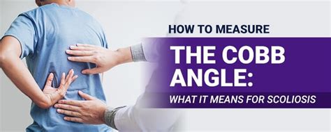 How to Measure the Cobb Angle: What it Means for Scoliosis